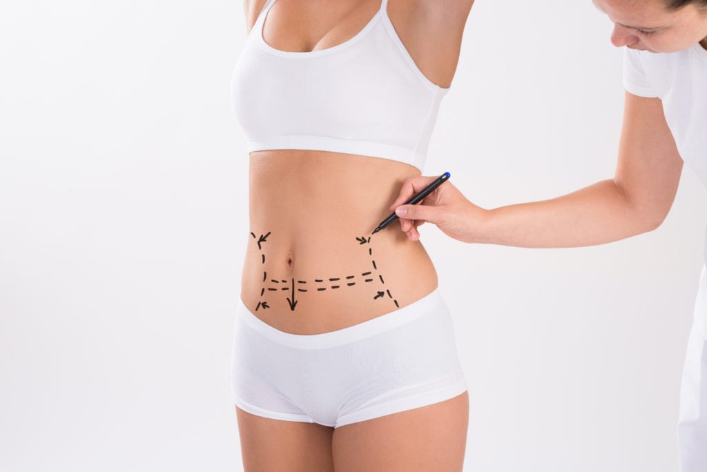 Is Tummy Tuck Surgery Right for Me?